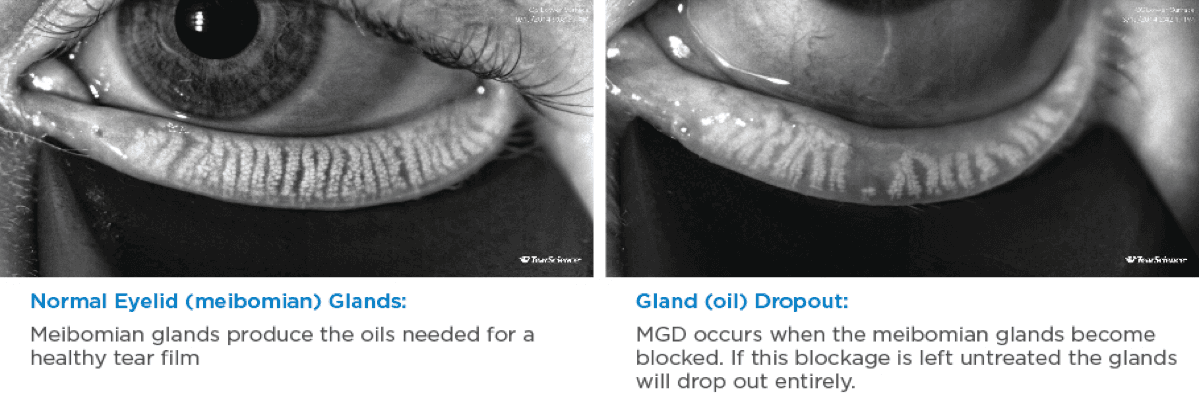 healthy eyelid and one with Meibomian Gland Dysfunction